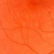 Diffuse Unilateral Subacute Neuroretinitis